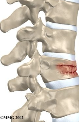 Compression fracture
