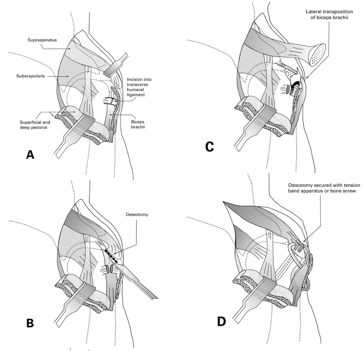 <ol><li><p>Conservative: Closed reduction under general anaesthesia. Assess range of motion &amp; stability, use splint for 2 weeks.</p></li><li><p>Surgical: lateral transposition &amp; tenodesis of biceps tend, trans-articular pinning, glenoid excisional arthroplasty, arthrodesis chronic</p></li></ol><p></p>
