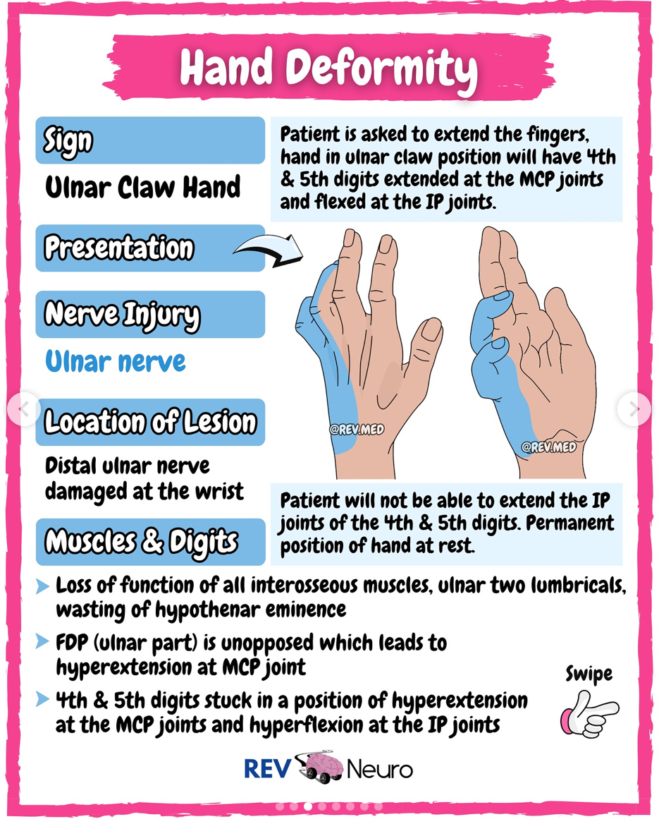 <p>Distal ulnar nerve lesion</p><p>-sensory loss ulnar side of palm/dorsal surface<br>-4th &amp; 5th digit hyperextension at MCP joints and flexion/inability to extend PIPs/DIPs</p><p>-Use MCP blocking splint AKA anti-claw splint to put MCPs in flexion</p>