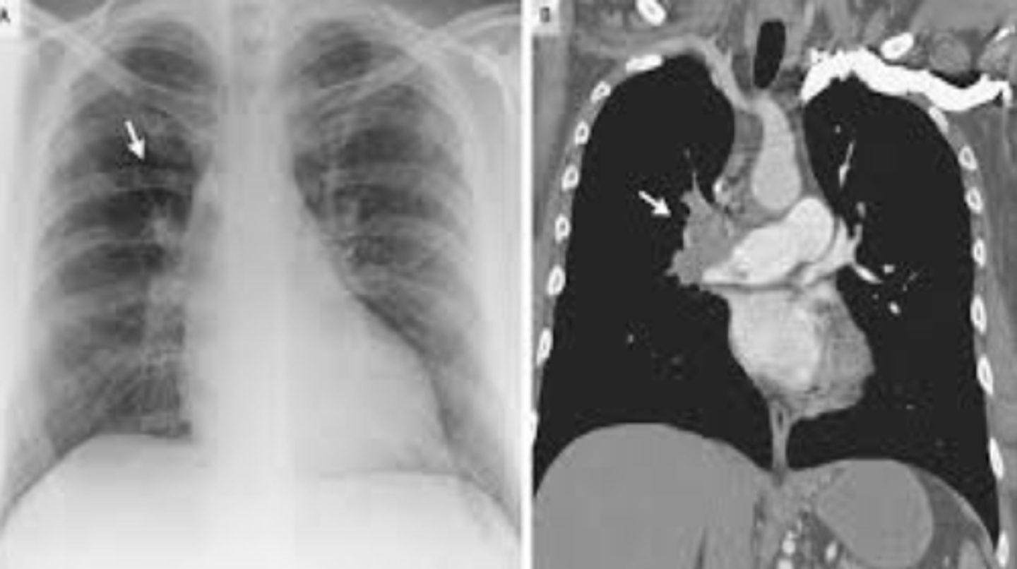 <p><b>PE</b> <br><br>-Westermark's sign= collapse of vasculature distal to the embolus and dilation of vasculature proximal to the embolus <br><br>-Hampton's Hump= wedge shaped infarct <br><br>-may also see atelectasis at bases or pleural effusion</p>