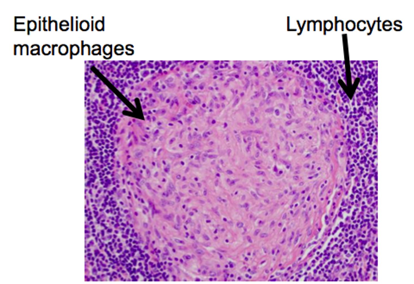 <p>- type of chronic inflammation due to the presence of granulomata</p><p>- this granuloma is a collection of macrophages surrounded by a ring of lymphocytes</p><p>- these macrophages are larger than normal and have a pink cytoplasm (they are called epithelioid cells)</p>