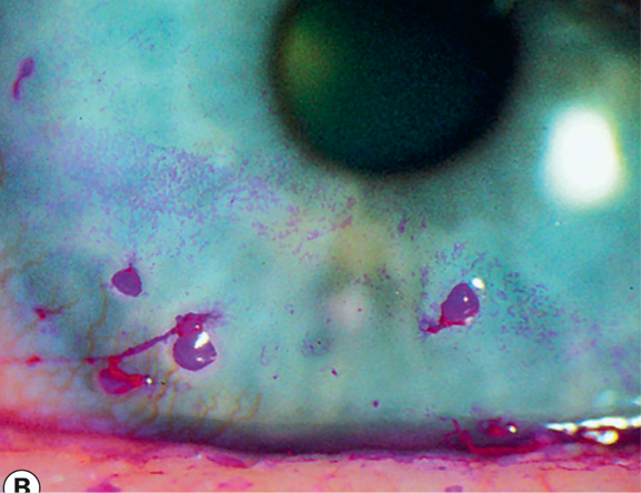 <ul><li><p><span>Mucus strands attached to the cornea</span></p><ul><li><p><span>Will attach where there is an epithelium break</span></p></li><li><p><span>Tear debris will surround mucus strand</span></p></li></ul></li><li><p><span>Commonly seen with dry eye, SLK</span></p></li></ul><p></p>