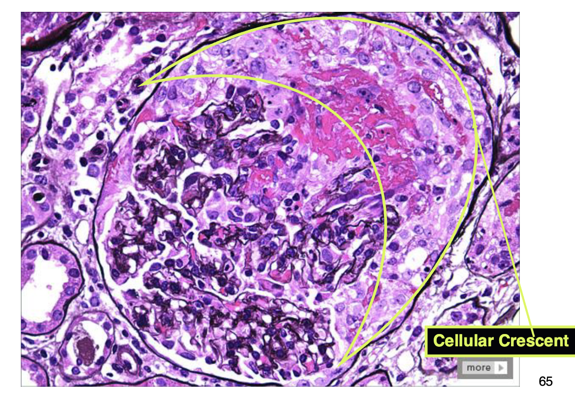 <ul><li><p>rapid and progressive destruction of glomeruli, can result in renal failure within weeks to months</p></li><li><p>the classic histologic picture is presence of <em>crescents</em> (hypercellularity with fibrin) in the glomeruli which obliterate Bowman’s space</p></li><li><p>many causes, often <strong>autoimmune diseases</strong>, example is <strong>Goodpasture’s syndrome</strong>: anti-GBM (also affects lungs)</p></li><li><p>grossly, kidneys are swollen, pale with “flea-bitten” petechial hemorrhages on the kidney surface</p></li><li><p>only treatment is dialysis and kidney transplant</p></li></ul><p></p>