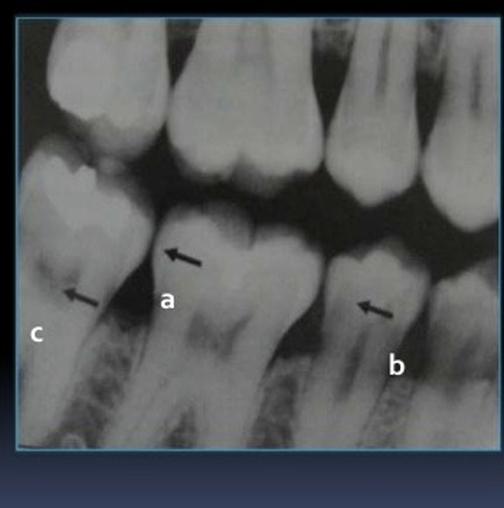 <p>Which anatomy of the teeth is it pointing at?</p>