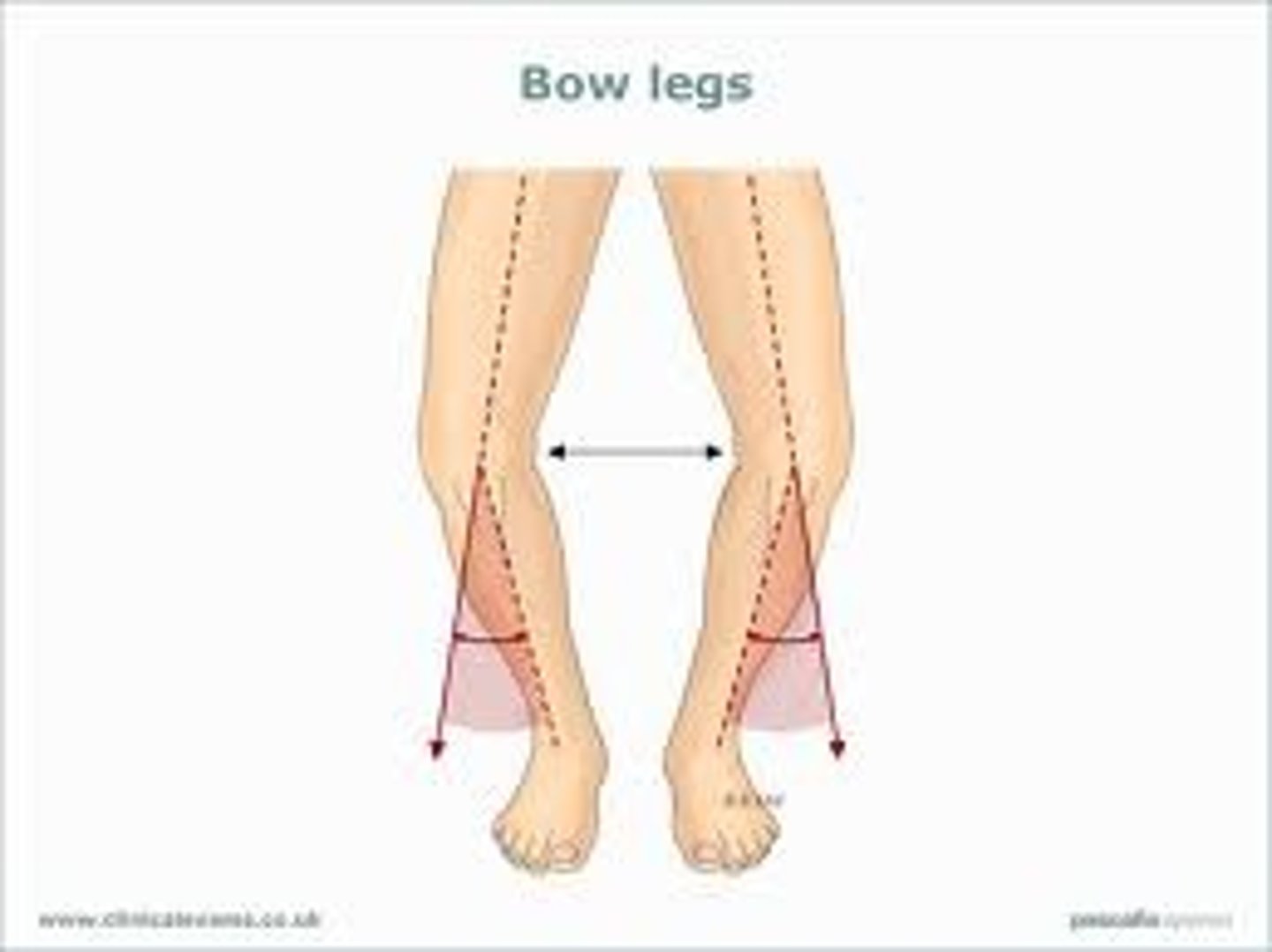 <p>- bow legs</p><p>- medial tibiofemoral less than 175 degrees</p>