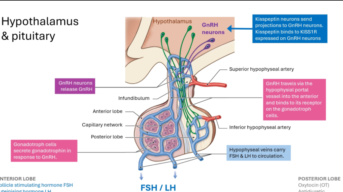 <p></p><p><span><strong>1) GnRH neurons (top of the diagram)</strong></span></p><ul><li><p><span>These neurons live in the hypothalamus.</span></p></li><li><p><span>They release GnRH.</span></p></li><li><p><span>GnRH release is pulsatile (short bursts).</span></p></li></ul><p></p><p><span>Important:</span></p><ul><li><p><span>Kisspeptin neurons stimulate GnRH neurons.</span></p></li><li><p><span>Kisspeptin is what helps switch puberty on.</span></p></li></ul><p></p><p><span><strong>2) GnRH does NOT go to the whole body</strong></span></p><ul><li><p><span>GnRH is released into a local capillary network at the base of the hypothalamus.</span></p></li><li><p><span>This is called the hypothalamo-hypophyseal portal system.</span></p></li></ul><p></p><p><span>Why this exists:</span></p><ul><li><p><span>GnRH would be diluted and broken down if released into general circulation.</span></p></li><li><p><span>The portal system delivers GnRH directly and efficiently to the pituitary.</span></p></li></ul><p></p><p><span><strong>3) GnRH reaches the anterior pituitary</strong></span></p><ul><li><p><span>GnRH travels down the infundibulum (the pituitary stalk).</span></p></li><li><p><span>It reaches the anterior pituitary only.</span></p></li><li><p><span>It binds GnRH receptors on gonadotroph cells.</span></p></li></ul><p></p><p><span>Key cell to remember:</span></p><ul><li><p><span>Gonadotrophs = LH + FSH producers</span></p></li></ul><p></p><p><span><strong>4) Pituitary response</strong></span></p><ul><li><p><span>Gonadotroph cells release:</span></p><ul><li><p><span>LH</span></p></li><li><p><span>FSH</span></p></li></ul></li></ul><p><span>These are released into normal bloodstream.</span></p><p></p><p><span><strong>5) LH and FSH go to the gonads</strong></span></p><ul><li><p><span>LH and FSH travel via circulation to:</span></p><ul><li><p><span>Testes or ovaries</span></p></li></ul></li></ul><p></p><ul><li><p><span>They stimulate:</span></p><ul><li><p><span>Sex steroid production</span></p></li><li><p><span>Gamete production</span></p></li></ul></li></ul><p></p><p></p>