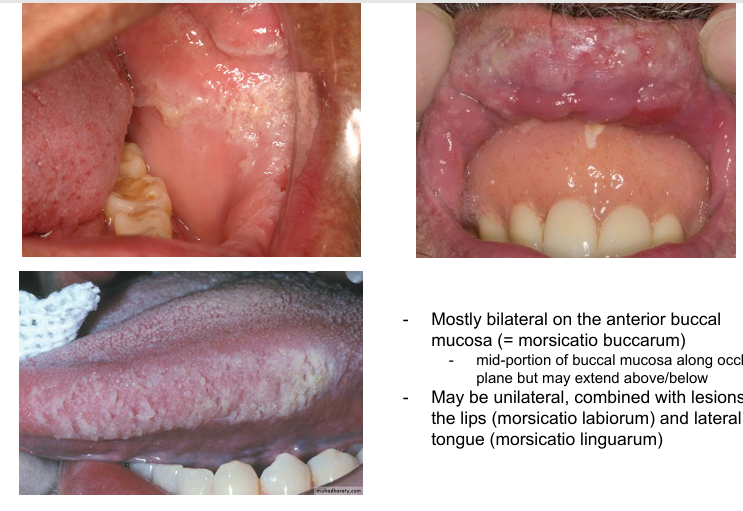 <p>-mostly bilateral on the anterior buccal mucosa (=morsicatio buccarum): mid-portion of buccal mucosa along occlusal plane but may extend above/below</p><p>-may be unilateral, combined with lesions of the lips (morsicatio labiorum) and lateral tongue (morsicatio linguarum)</p>