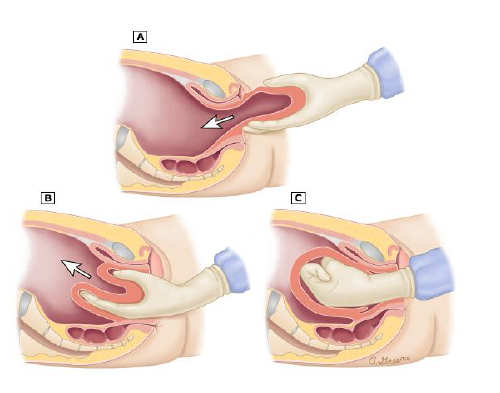 <p>1. PREVENTION</p><p>✓ Never apply pressure on an uncontracted uterus</p><p>✓ Never pull the cord to hasten placental delivery</p><p>2. If the placenta has already separated: the uterus is replaced in the uterine cavity then oxytocin is administered.</p><p> 3. If the placenta is still attached: woman is placed under anesthesia to cause muscular relaxation and facilitate reinsertion of the uterus into the pelvic cavity. 4. Blood transfusion and administration of IVF </p><p>5. Monitor vital signs</p>