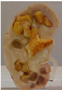 <p>Magnesium ammonium phosphate (__) stones- often associated w <strong>bacterial infection</strong>/<strong>UTI </strong>(common in AFAB)<br>– bacteria secrete urease which converts urea →ammonia which makes urine <strong>alkaline </strong>and this promotes formation of stone<br>– <em>can grow into staghorn calculi (pic)</em></p>