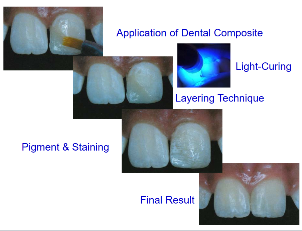 <p>layering; pigment staining and light-curing </p>