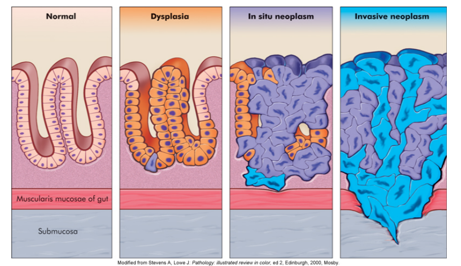 <ul><li><p>epithelial malignant tumors that have <em>not</em> broken through or invade the surrounding stroma (can be cut out cleanly)</p></li></ul>