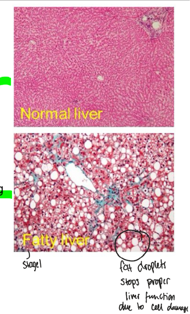 <p><span>1. fatty liver&nbsp;</span><br><span>2. alcohol hepatisis, group of cells die resulting in inflammation</span><br><span>3. cirrhosis including fibrosis, scarring and cell death&nbsp;</span></p>