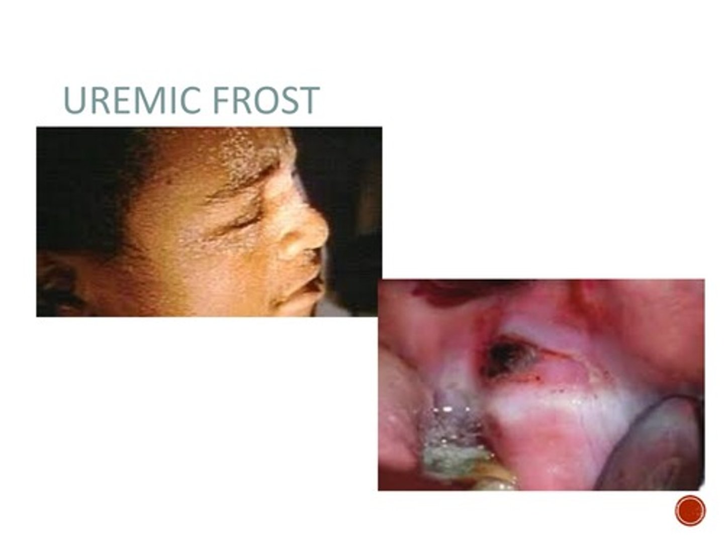 <p>In severe renal failure, this type of stomatitis may be present. Early changes typically include red, burning, mucosa covered with grey exudates and later by frank ulceration. Adherent white patches called “uremic frost”, caused by urea crystal deposition, are more common on the skin but may be seen on the oral mucosa. Bleeding tendencies are evident as petechiae and ecchymoses on the labial and buccal mucosa, soft palate, and margins of the tongue, and is gingival bleeding.</p>