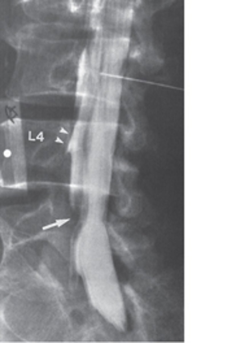 <p>In Case 13-2, the lesion represented by an arrow is most likely to be</p><p>a right-sided L4-5 herniated nucleus pulposus.</p><p>an extradural tumor.</p><p>an epidural abscess.</p><p>an intradural mass.</p><p>a bony lesion.</p>