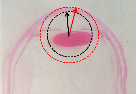 <p>Anterior: 7.8 mm</p><p>Posterior: 6.5 mm </p>