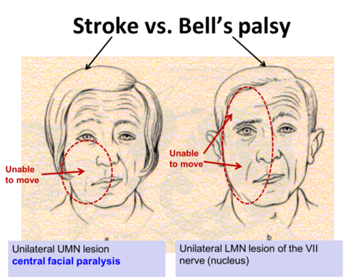<p>bells palsy!!!! → includes forehead</p><p>stroke spares forehead → able to lift brows and have forehead wrinkling</p>