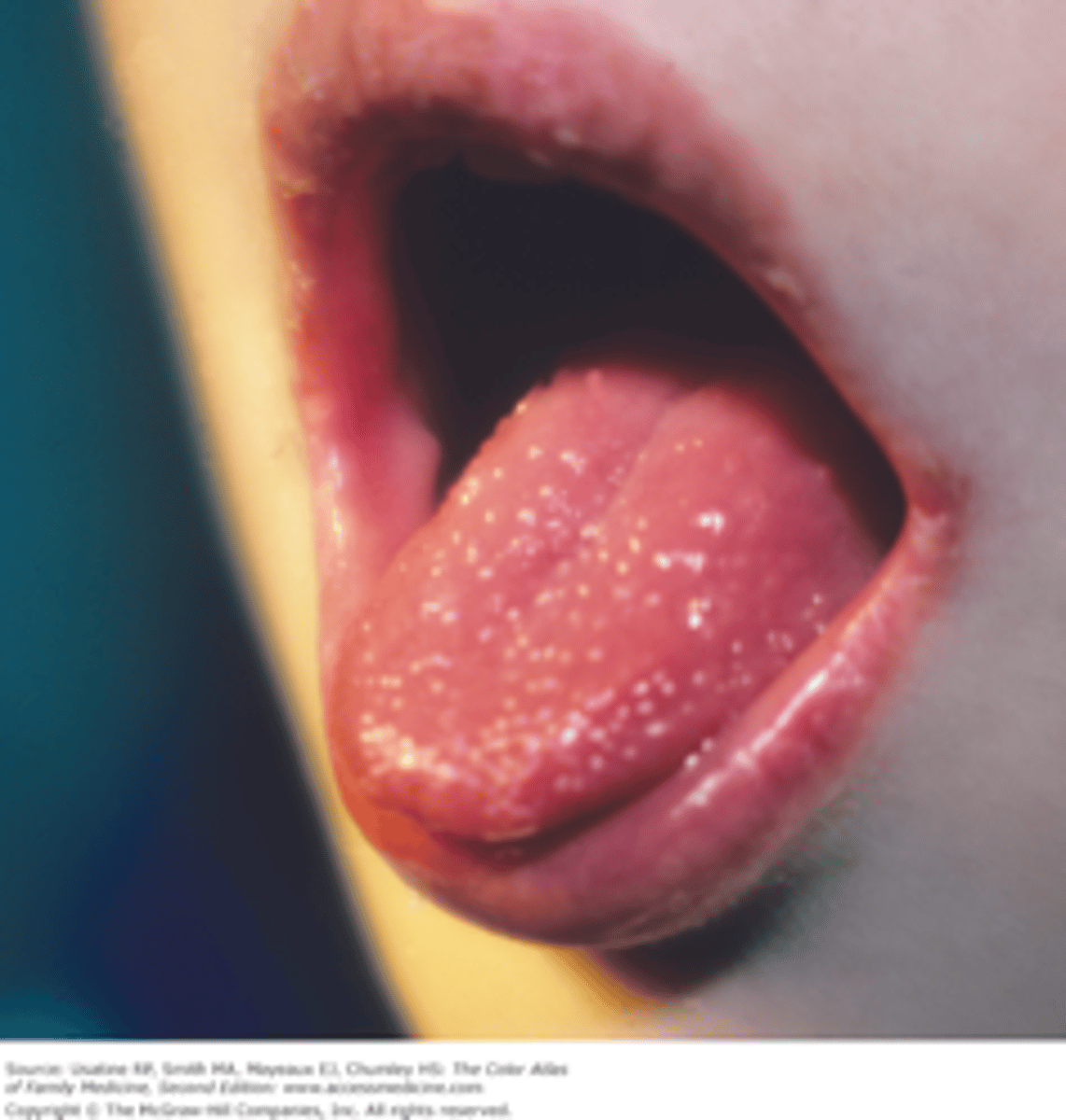 <p>swollen, red and papillae become enlarged, white and prominent</p>