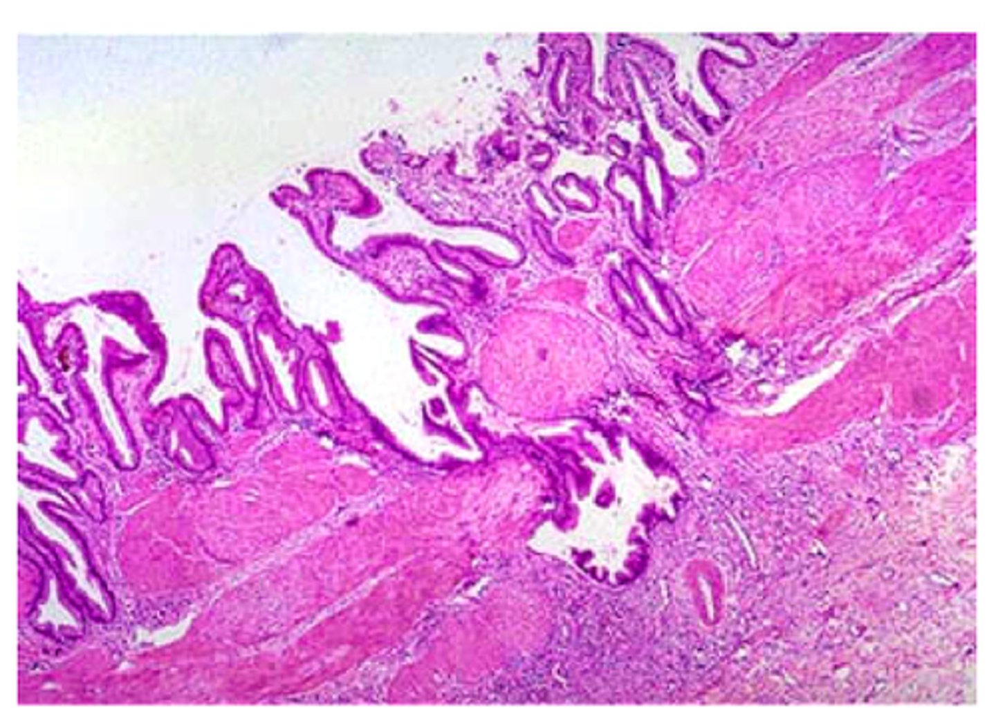 <p>What is a Rokitansky-Aschoff sinus? What condition is it characteristic of?</p>