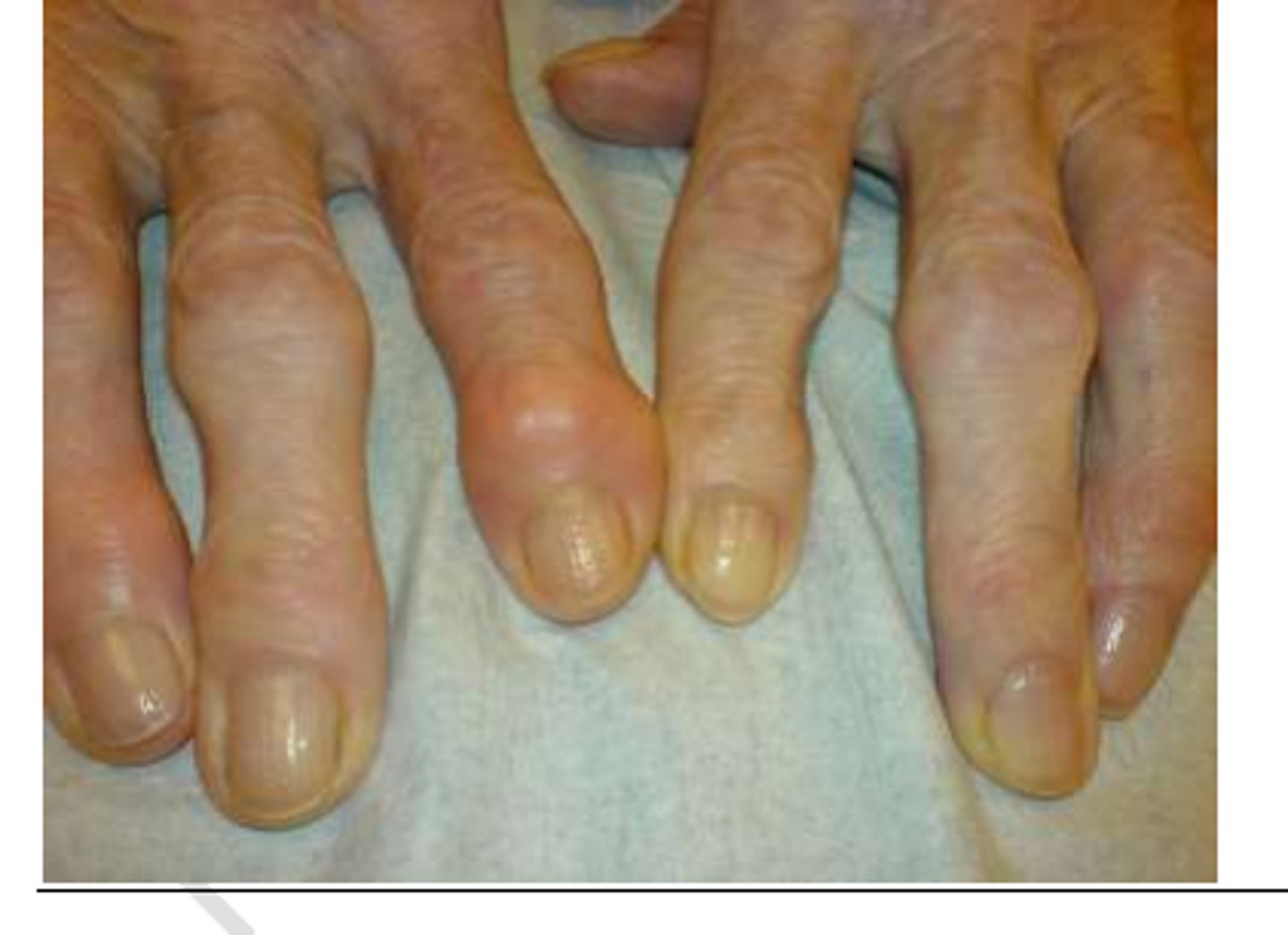 <p>Distal interphalangeal joint nodules that deviate.</p>