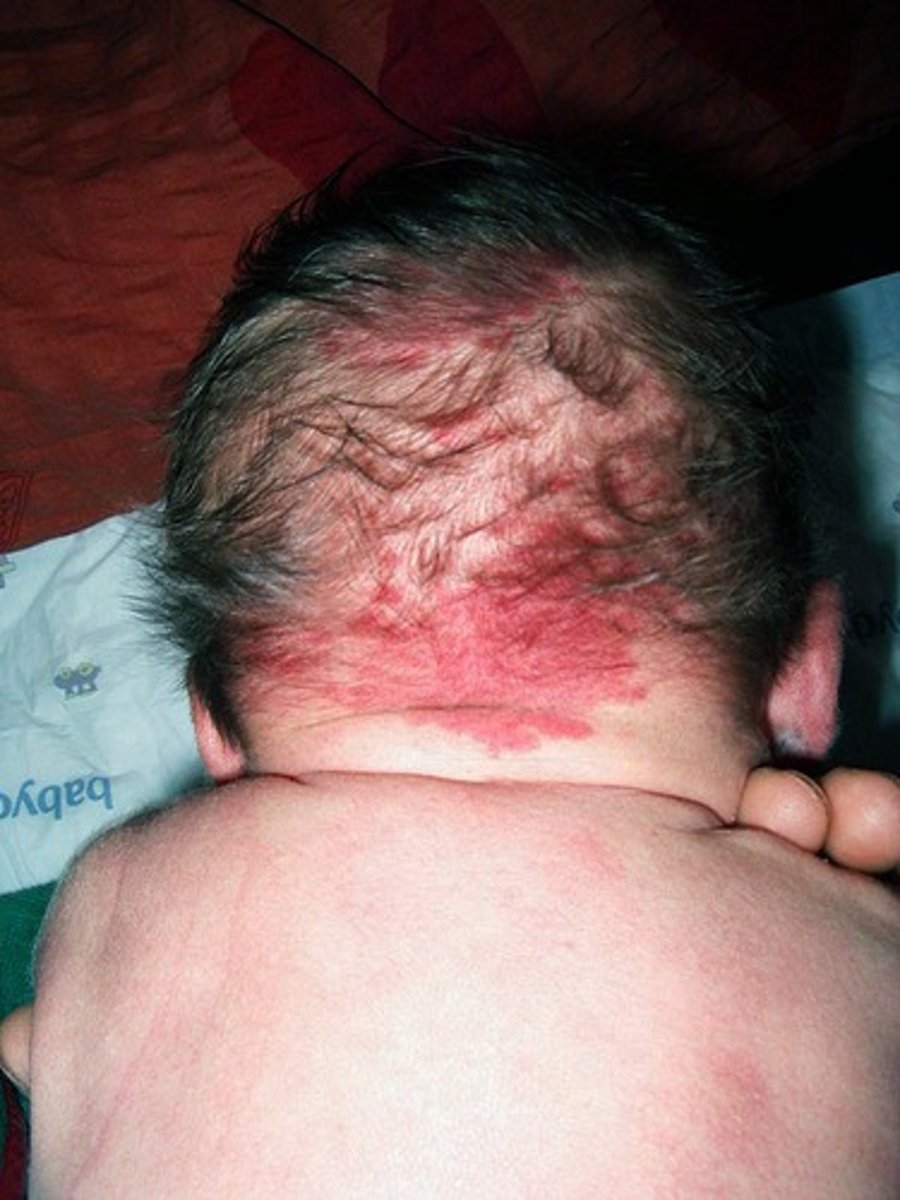 <p>Type of port wine stain</p><p>Stork bite</p><p>Present in 1/3 of newborns</p>