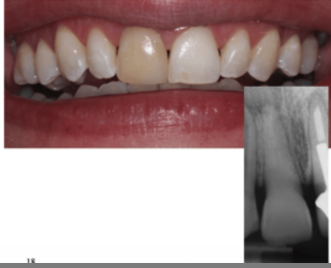 <p>Calcific Metamorphosis/ Pulpal Canal Obliteration PCO/Trauma</p>