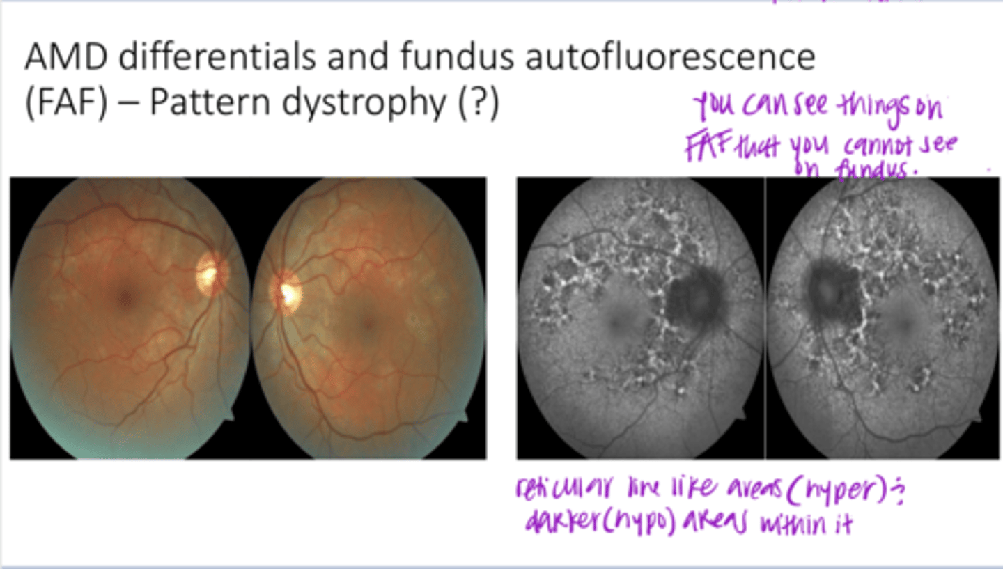 <p>AMD Differentials and Fundus Autofluorescence -- Pattern Dystrophy or Inflammatory Disease?? (FAF)</p><p>**reticular (line like) areas of lipofuscin (hyper) and within are darker areas (hypo)</p>