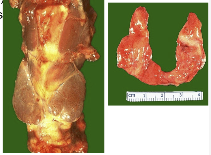 <p>What disease is this</p>