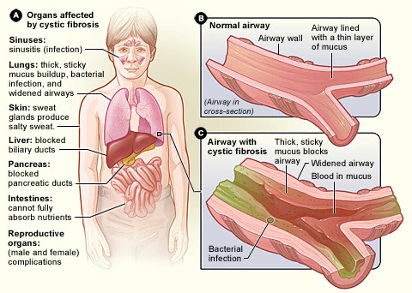 <p>A genetic disorder that is present at birth and affects both the respiratory and digestive systems.</p>