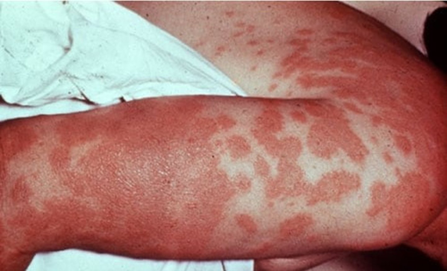 <p>causes lung infections, valley fever and infections of the skin</p>