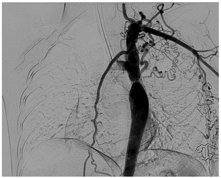 <p>Imaging from a 17-year-old male with lower limb claudication reveals the result shown in the accompanying image. Which of the following arteries plays the most significant role in carrying blood around this blockage?</p><p></p><p>A. External carotid</p><p>B. Internal thoracic</p><p>C. Lateral thoracic</p><p>D. Profunda brachial</p><p>E. Superior gluteal</p><p>F. Vertebral</p>