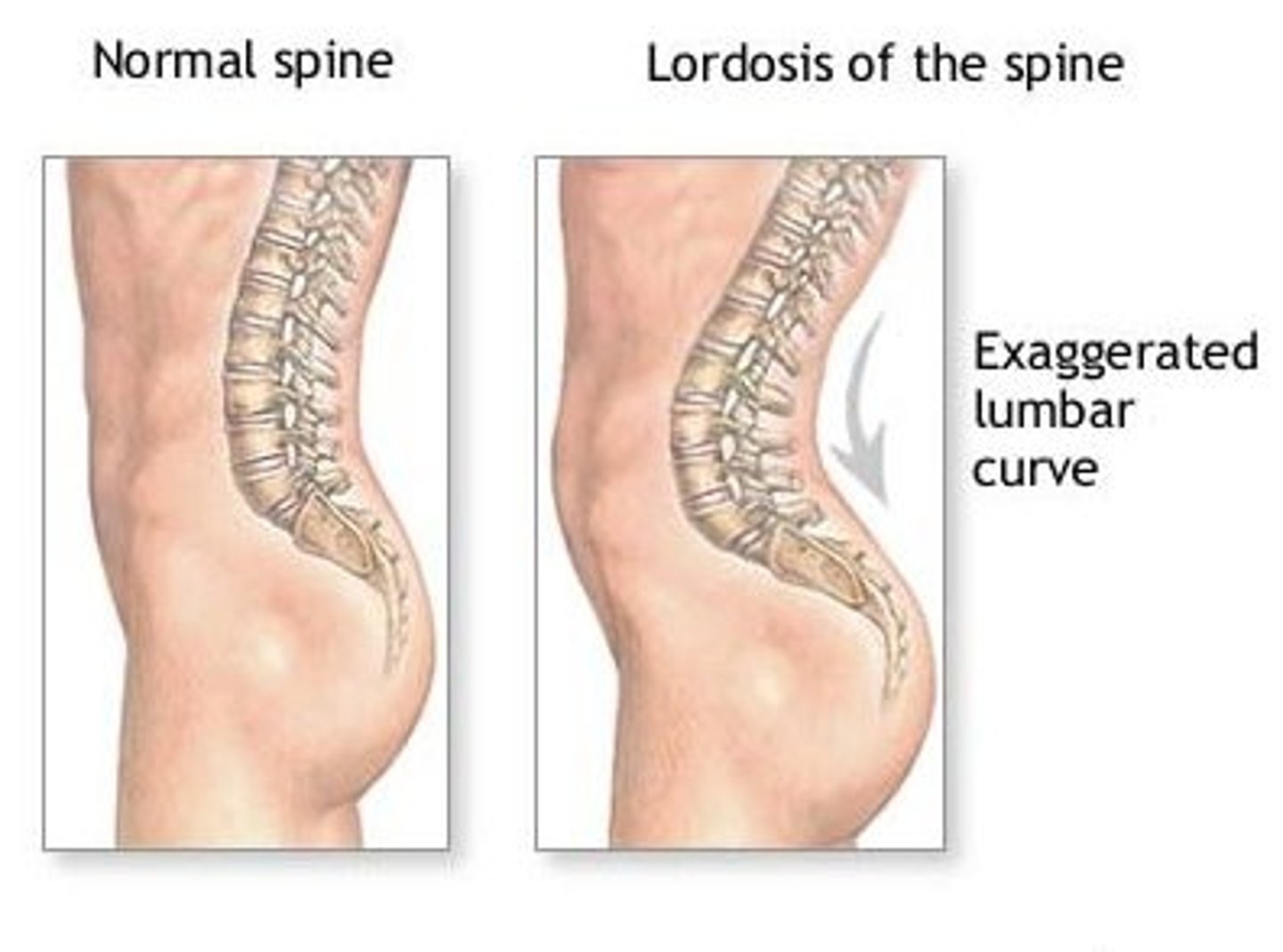 <p>abnormal anterior curvature of the lumbar spine (sway-back condition)</p>