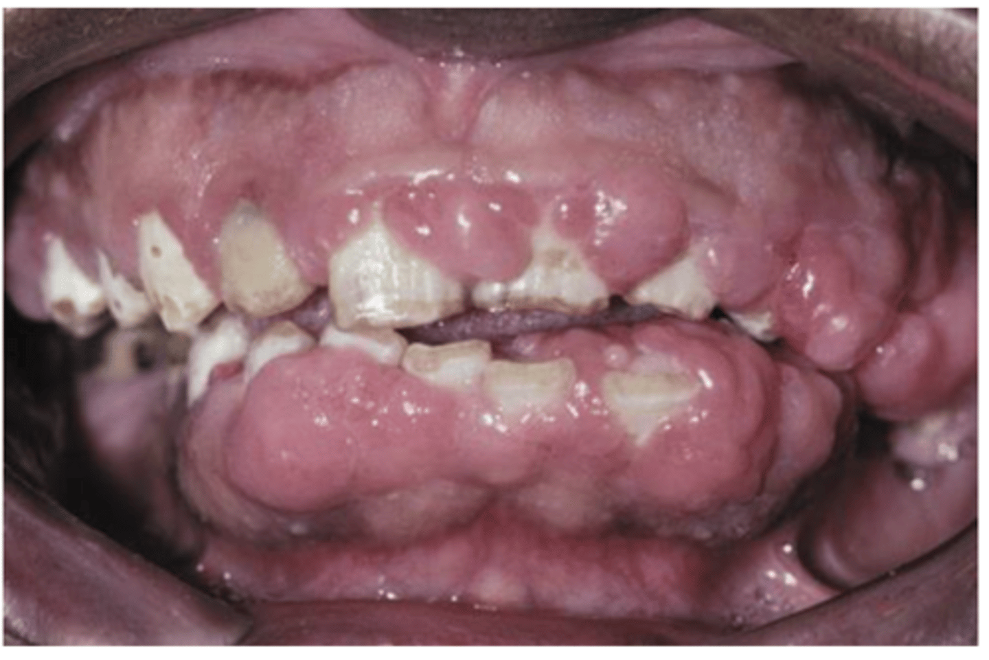 <p>• Begins in the interdental</p><p>papillae</p><p>• Gingiva may cover the crowns</p><p>• Firm</p>