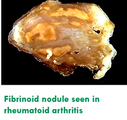 <ul><li><p>occurs in connective tissue, blood vessel walls in hypertension and autoimmune disease</p></li><li><p>collagen degenerates, resembles fibrin but not true fibrin</p></li><li><p>fibrinoid nodule seen in rheumatoid arthritis</p></li></ul><p></p>