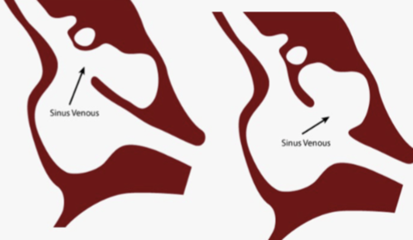 <p>absence of tissue between the RUPV and SVC</p>