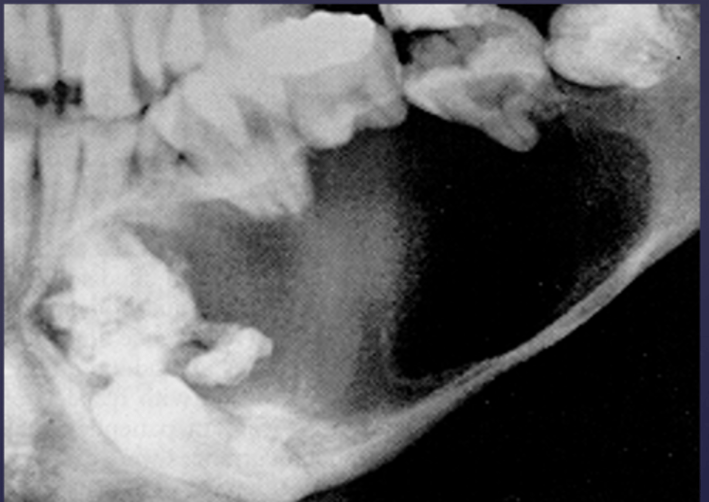 <p>What would be a differential diagnosis for this lesion?</p>