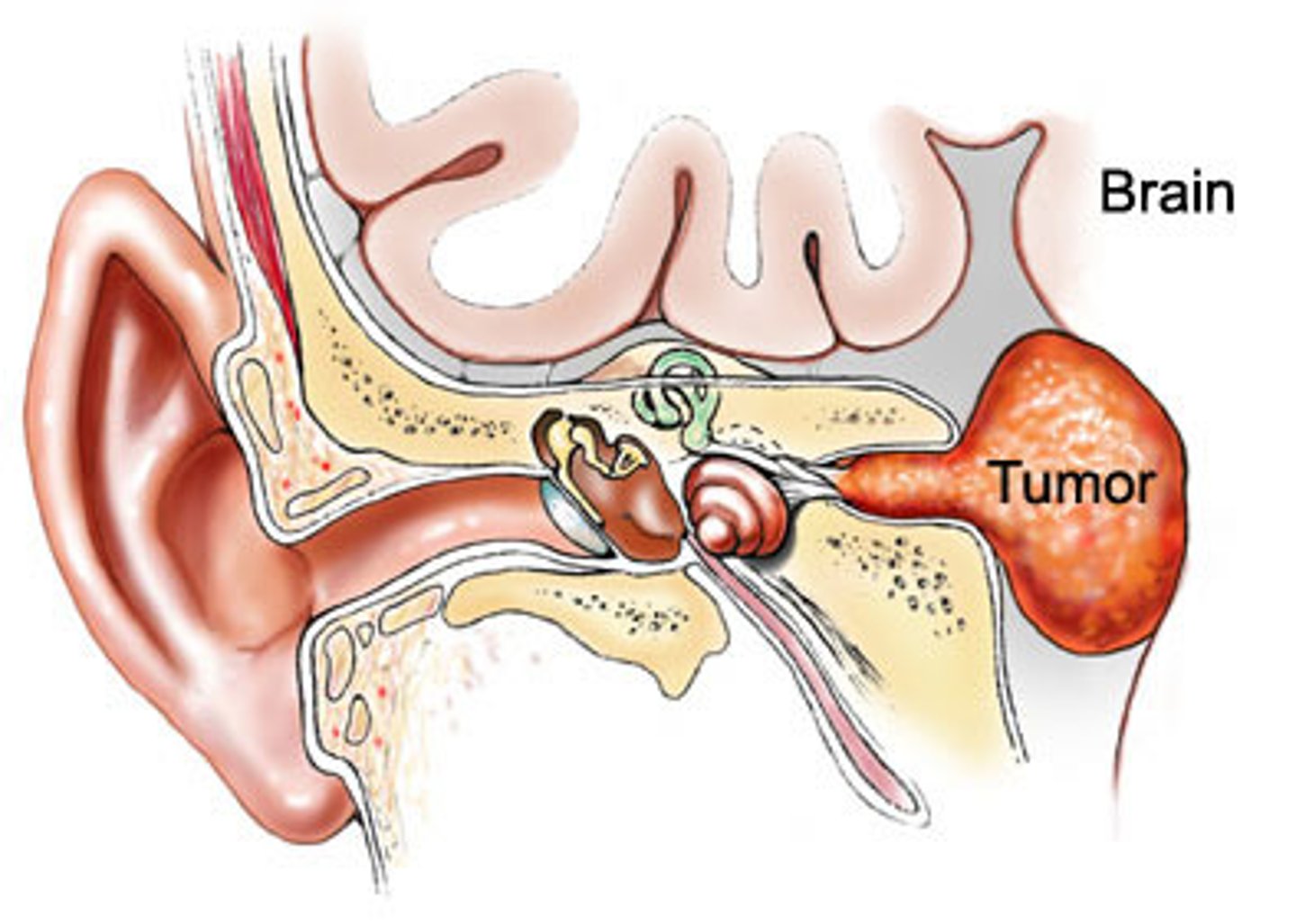 <p>tumor on the acoustic nerve (CN 8)</p>