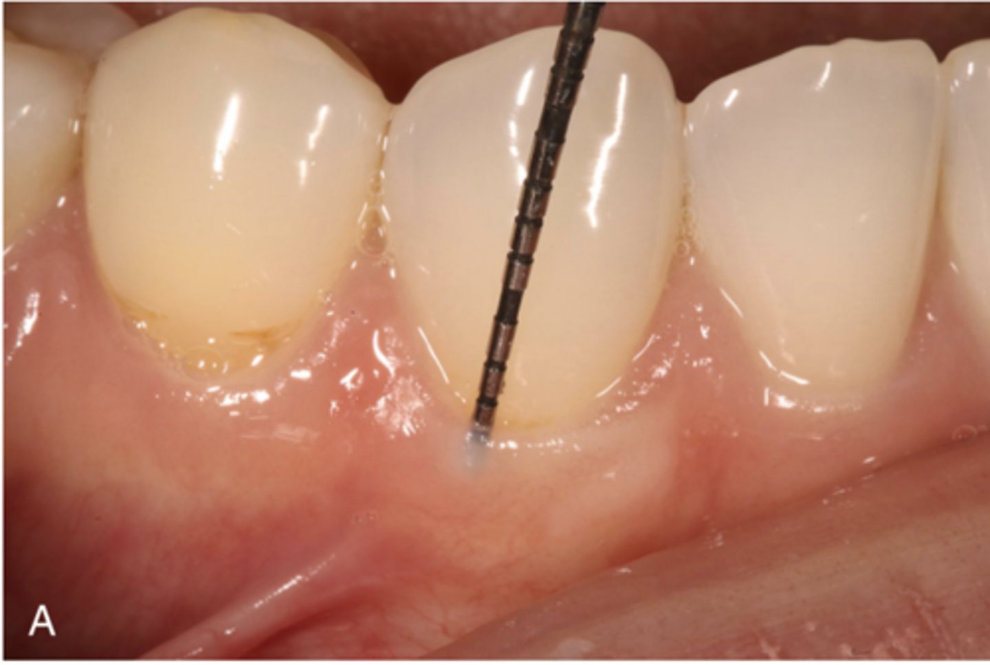 <p>The gingival sulcus is the shallow crevice or space around the tooth bounded by the surface of the tooth on one side and the epithelium lining the free margin of the gingiva on the other side. It is V-shaped and barely permits the entrance of a periodontal probe.</p><p>The clinical determination of the depth of the gingival sulcus is an important diagnostic parameter.. in clinically healthy human gingiva, a sulcus of some depth of a clinically normal gingival sulcus in humans is 1 to 3 mm without visible bleeding</p>