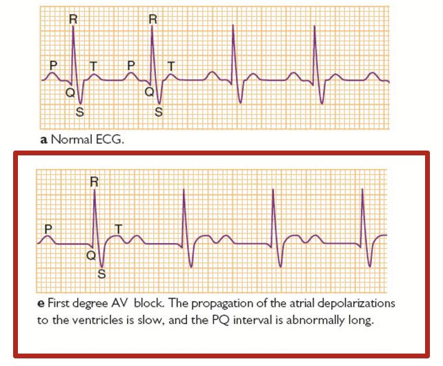 <p>Condition of abnormally slow conduction through the AV node. Generally asymptomatic and only discovered on routine ECG.</p><p>There is a dysfunctional of the heart where there is a long lag after atrial contraction. We can usually see an abnormally long gap between the P and Q waves here.</p>