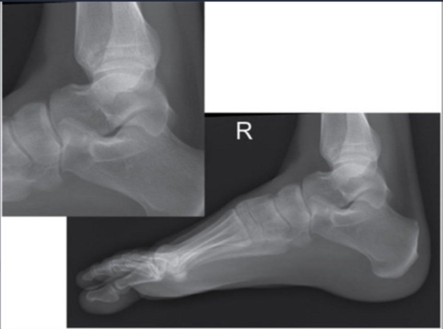 <p>Foot elevated</p>