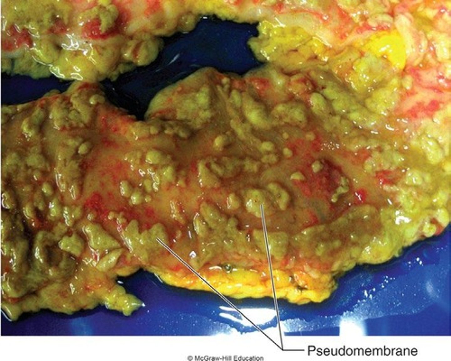 <p>The presence of pseudomembranes on the colon.</p>