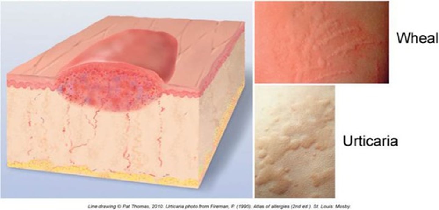 <p>Irregular, transient, superficial area of localized skin edema<br>urticaria = more than 1 skin wheel</p>