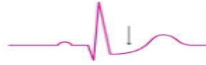 <p>What is the rhythm?</p>