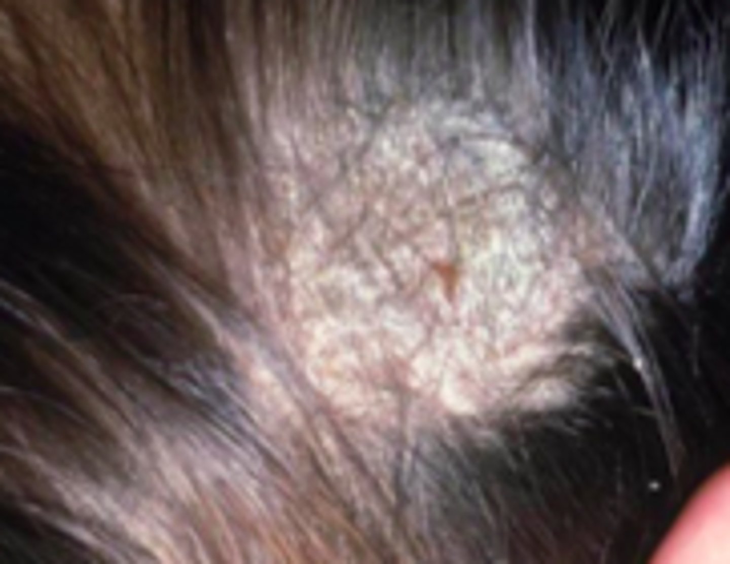 <p>Fungal ID:</p><p>Development of scaly patches with alopecia and patches of alopecia with visible black dots</p>