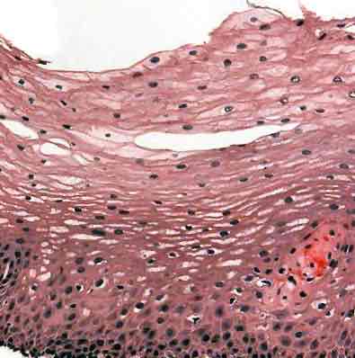 <p>stratified squamos (epithelial)</p>