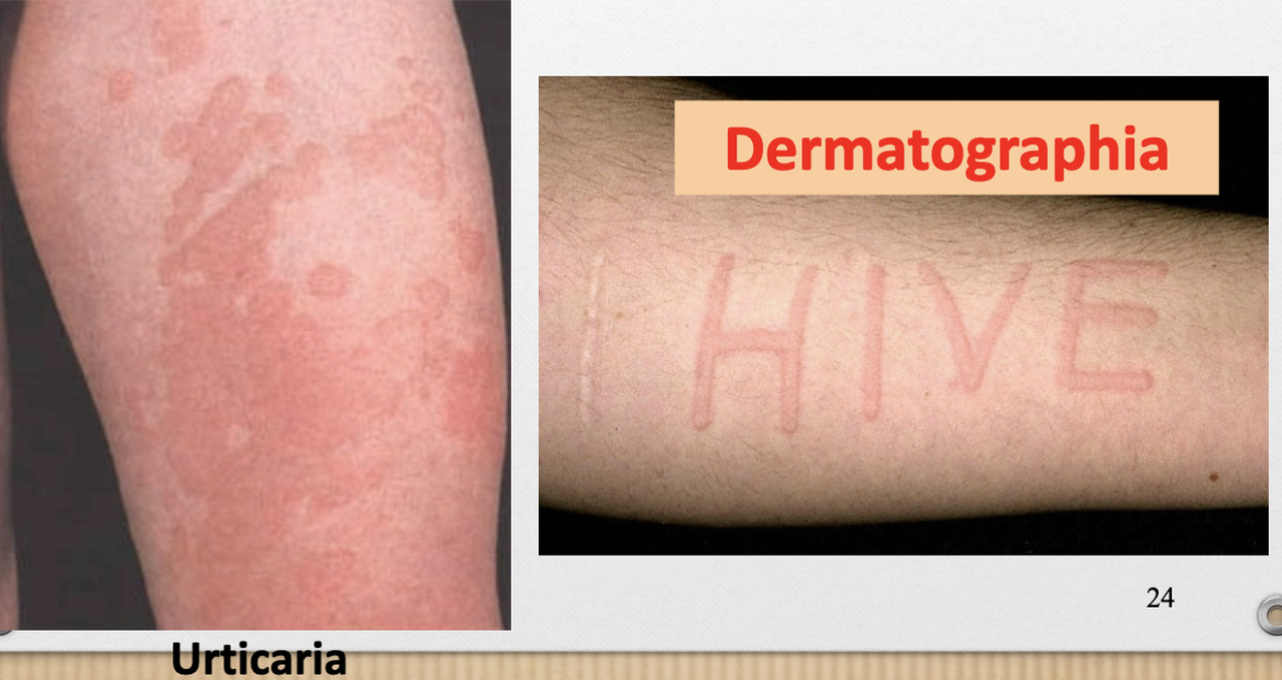 <p>ex. urticaria, dermatographia (hive)</p>