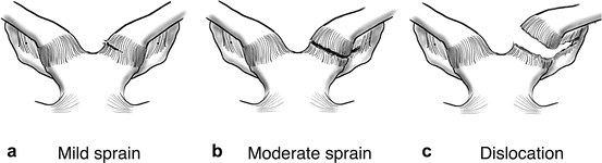 <p>Diagnose this injury. Provide Moi, signs and symptomsand management</p>