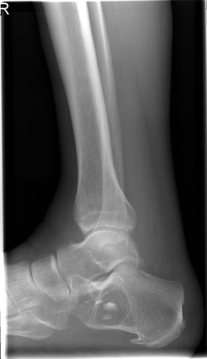 <p>What is going on with the posteroinferior calcaneus?</p>