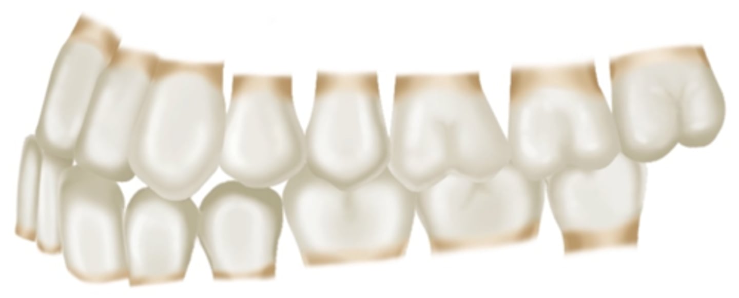 <p>ID the occlusion classification:</p>