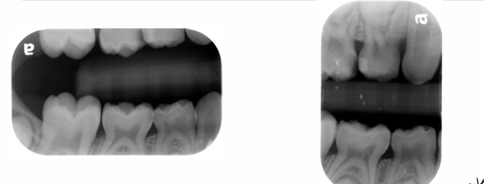 <p>-vertical easier to tolerate for pts who gag</p>