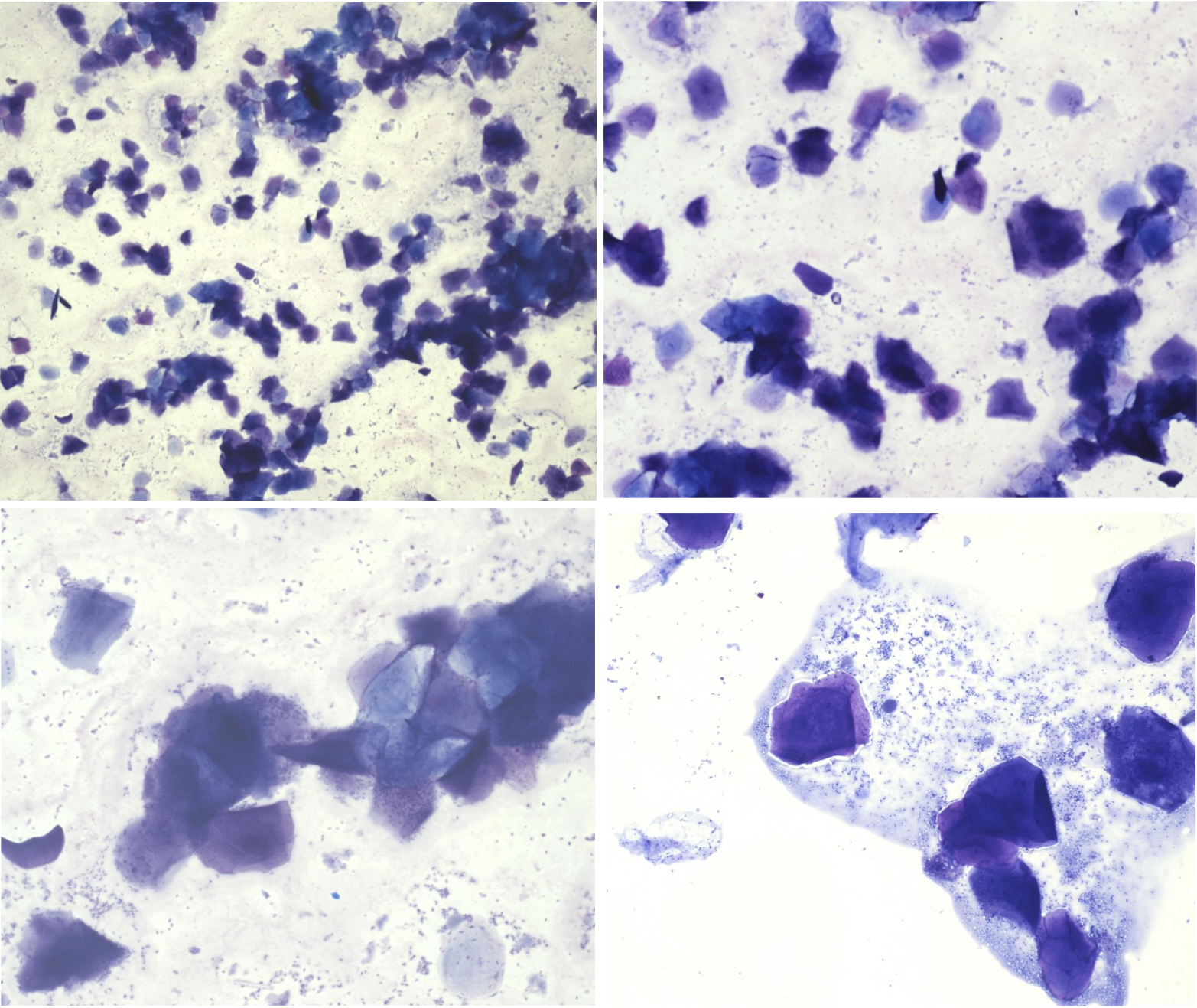 <p>Utstryk 7<br>Parabasalceller: <br>Intermediärceller: <br>Superficialceller: <br>Erytrocyter: <br>Neutrofiler:</p><p>Stadium:</p>